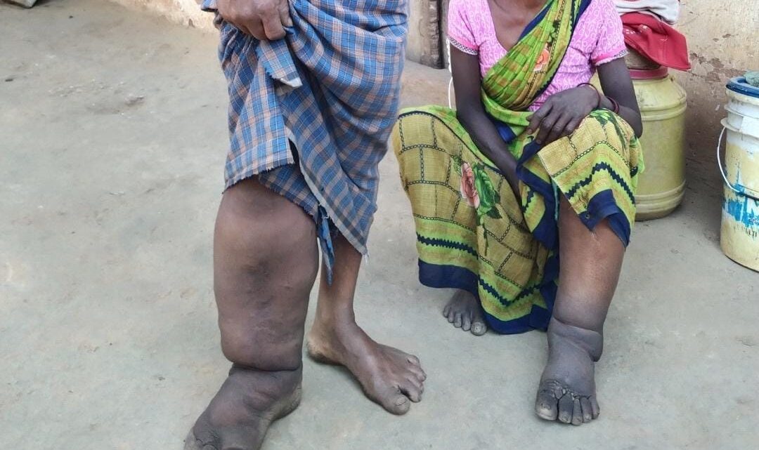 जिले के हर व्यक्ति को फाइलेरिया की दवाई खिलाकर जड़ से किया जाएगा उन्मूलन जिले के हर व्यक्ति को फाइलेरिया की दवाई खिलाकर जड़ से किया जाएगा उन्मूलन